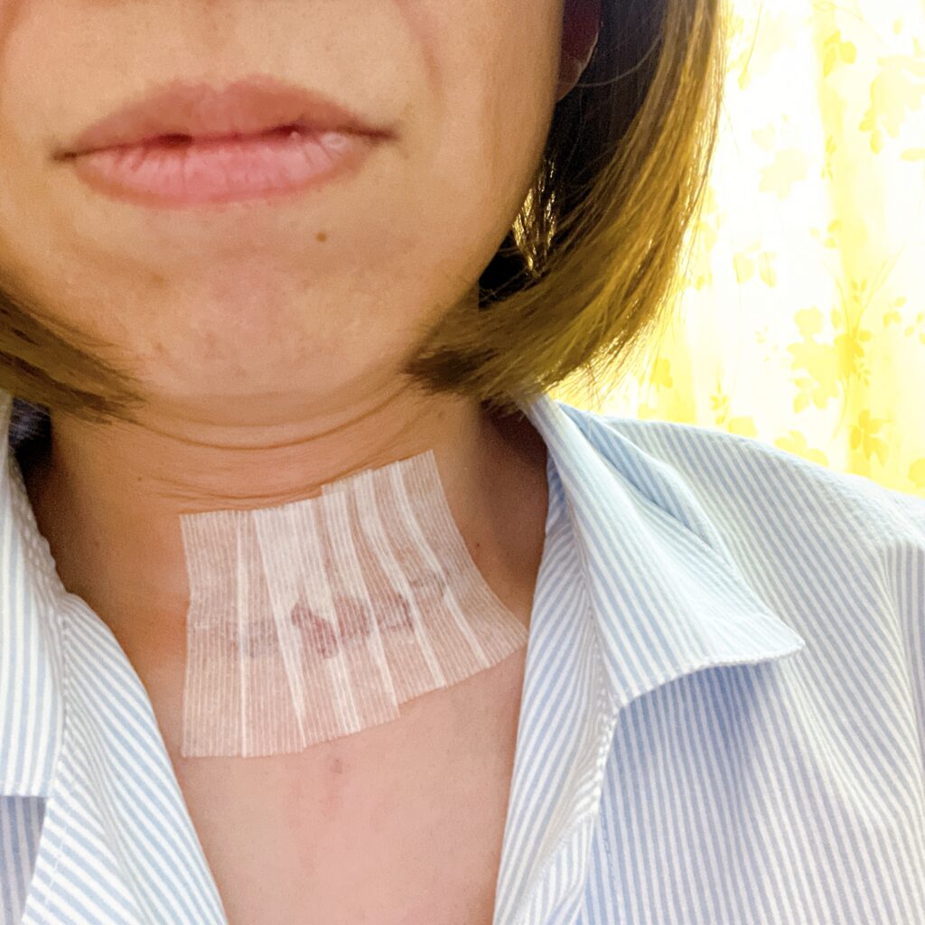 甲状腺乳頭癌術後の傷