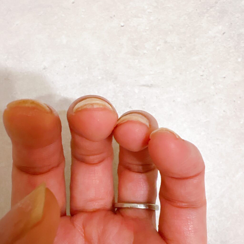 爪甲剥離症